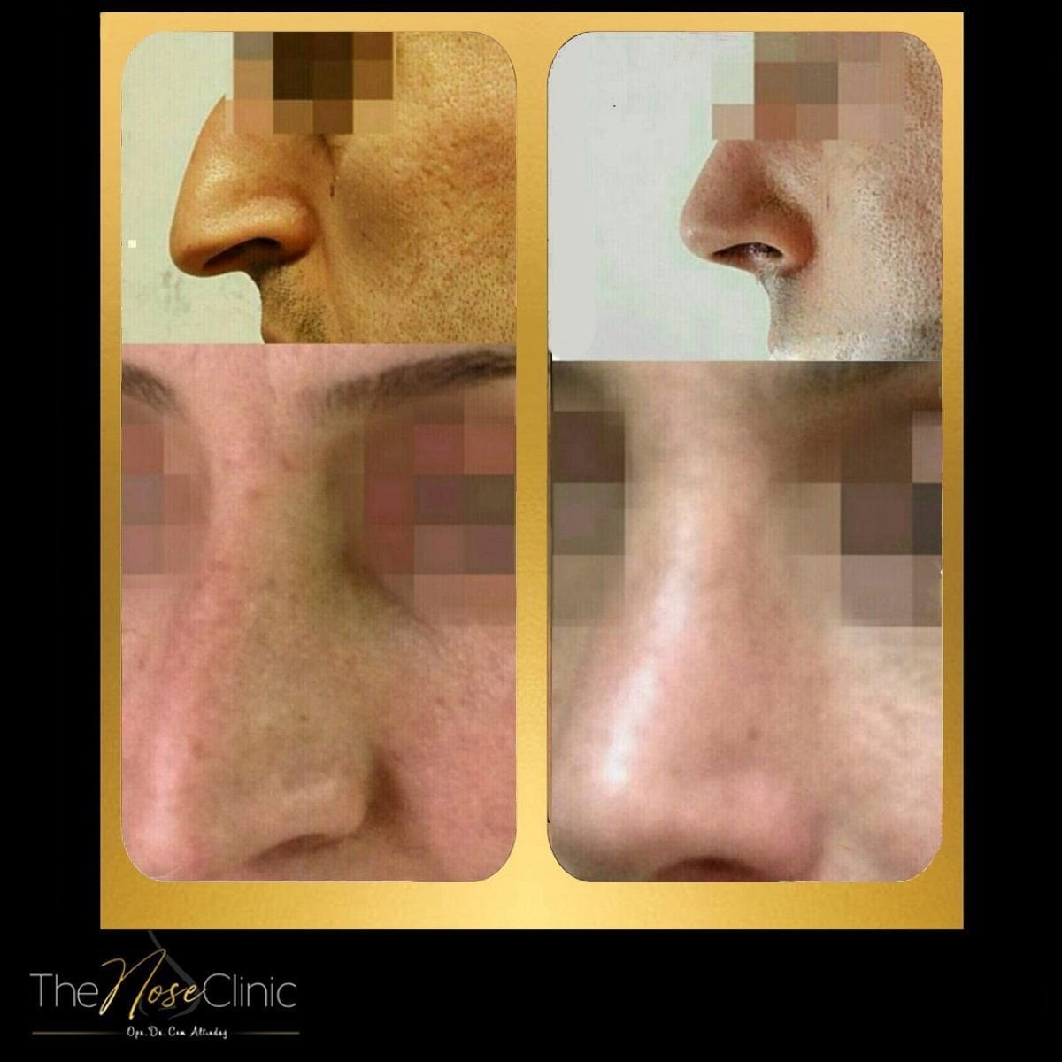 نتائج قبل وبعد عملية تصحيح الحاجز الأنفي في The Nose Clinic، تحسين التنفس والتناسق