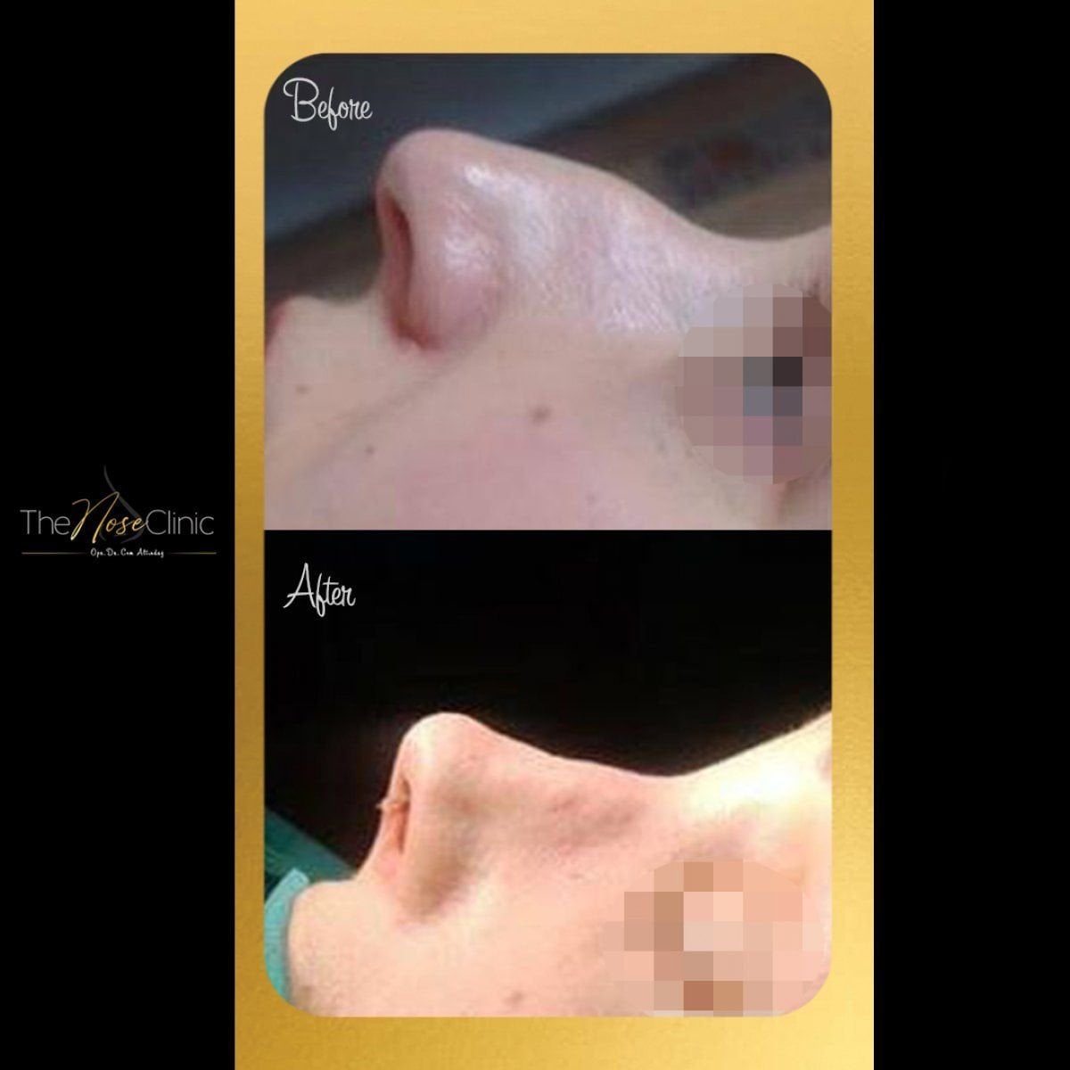 نتائج قبل وبعد عملية تصحيح انحراف الحاجز الأنفي في The Nose Clinic وتحسن شكل الأنف