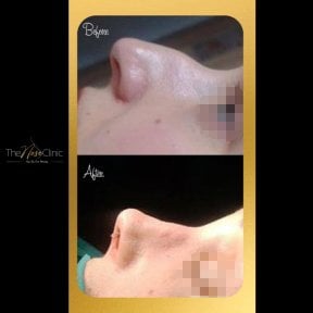 Результаты септопластики до и после в The Nose Clinic, улучшенный профиль носа