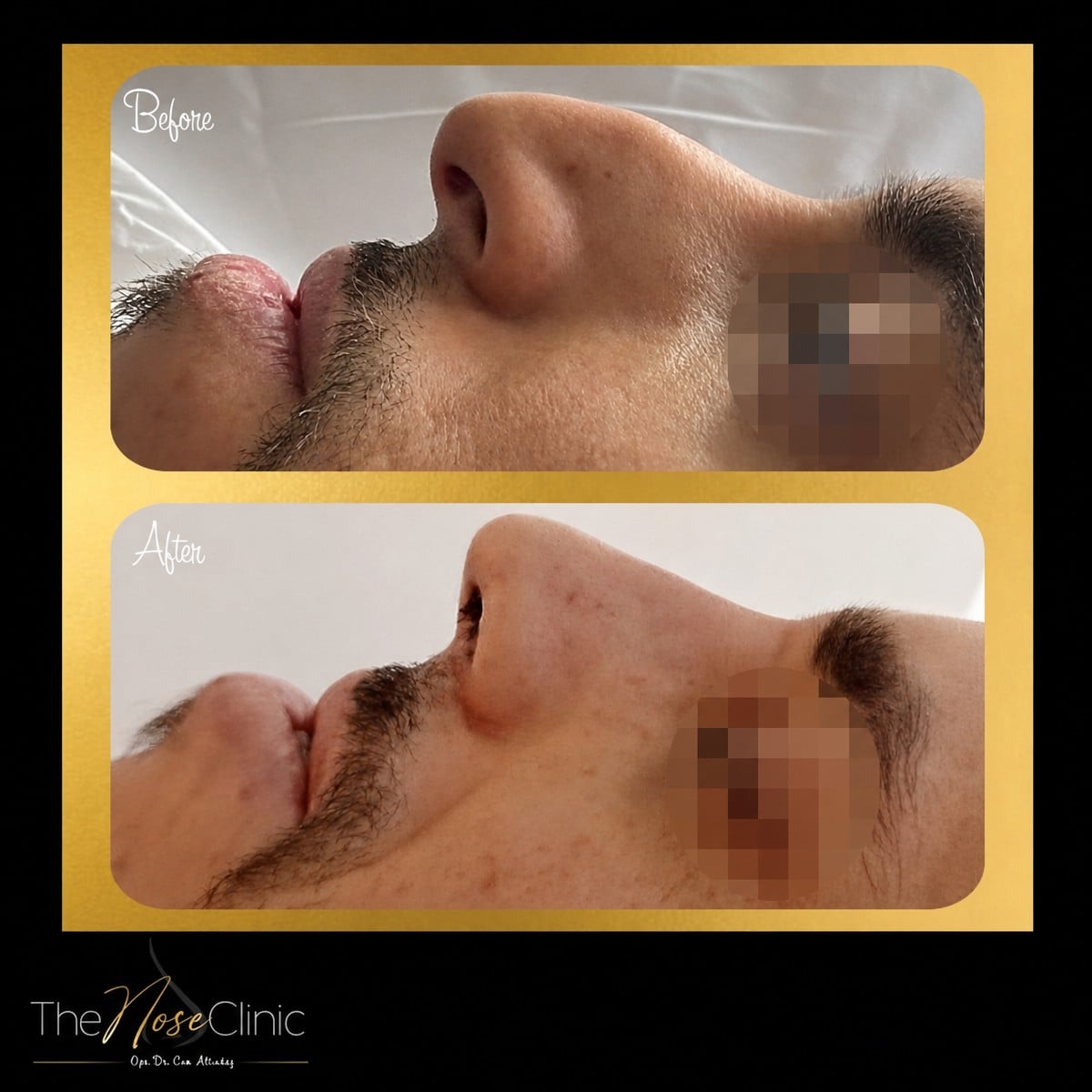 نتائج قبل وبعد عملية تصحيح الحاجز الأنفي في The Nose Clinic، تحسين التنفس والشكل