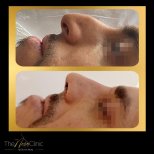 Фото до и после септопластики, доктор 