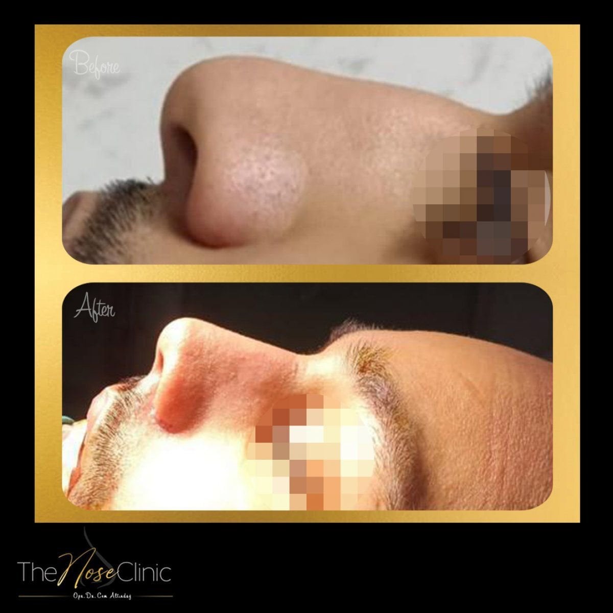 نتائج قبل وبعد عملية تصحيح انحراف الحاجز الأنفي في The Nose Clinic