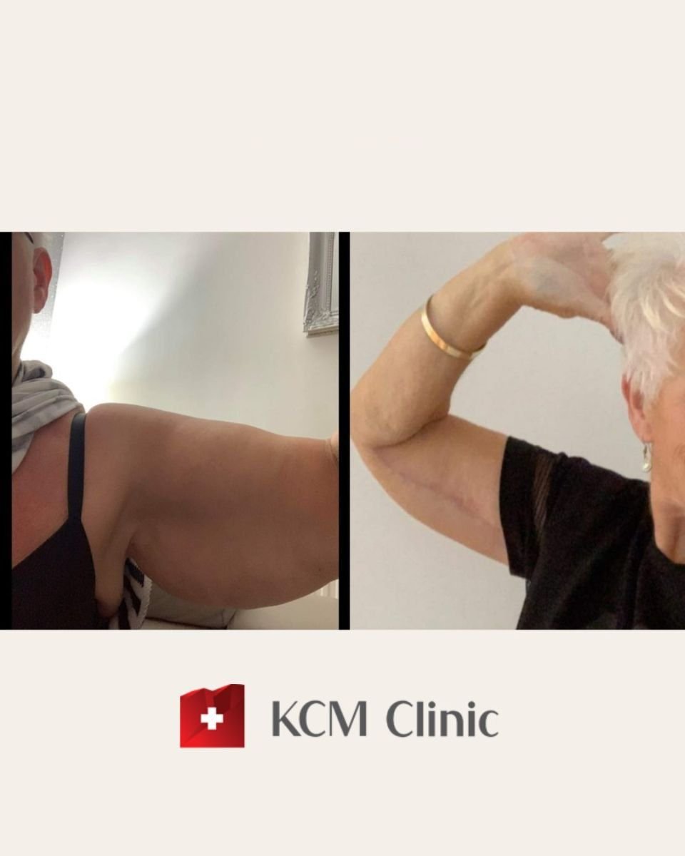 Resultados antes y después de lifting de brazos en KCM Clinic, mejor contorno tras braquioplastia