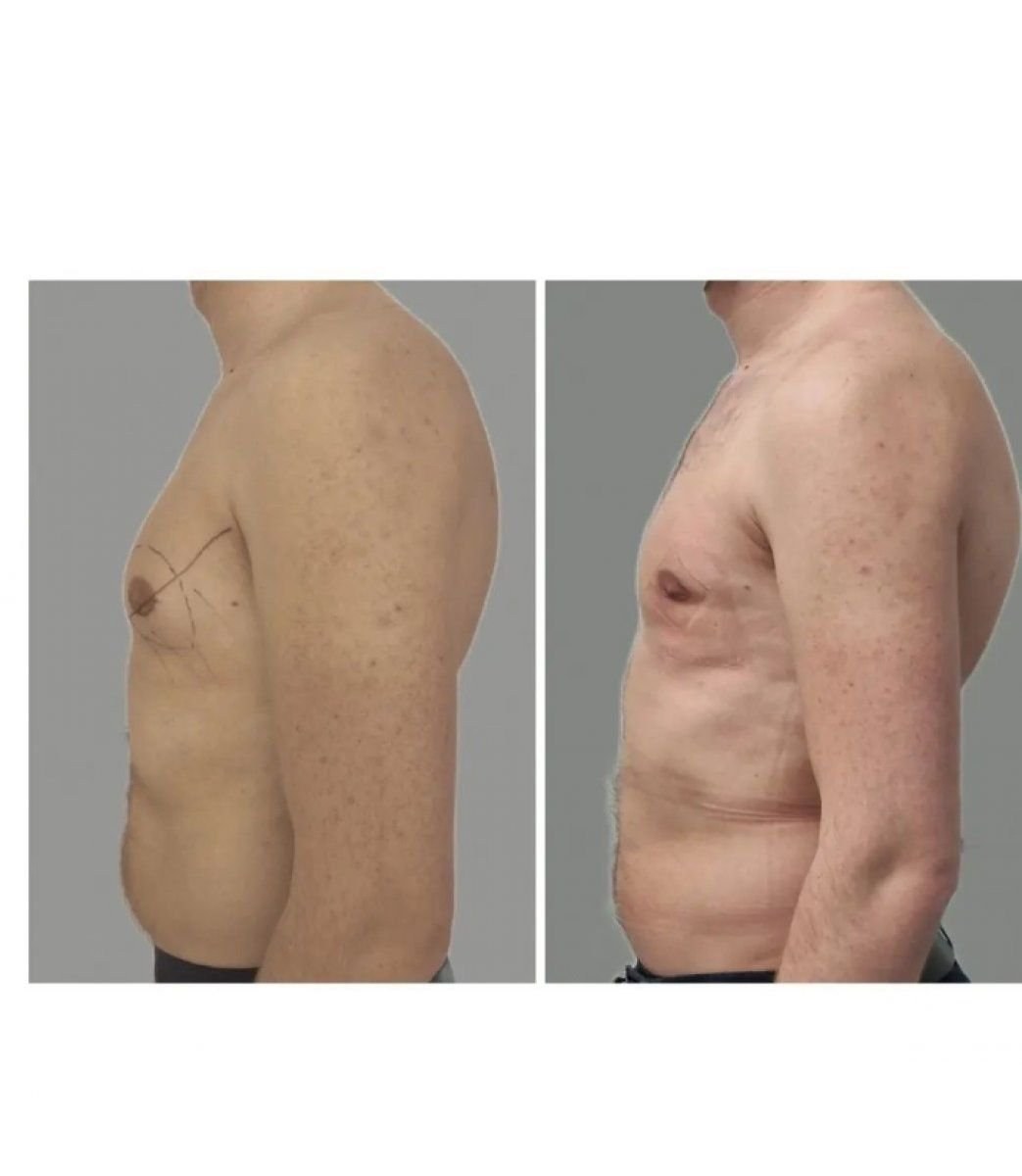 نتائج قبل وبعد جراحة التثدي في KCM Clinic – تحسين شكل صدر الرجل