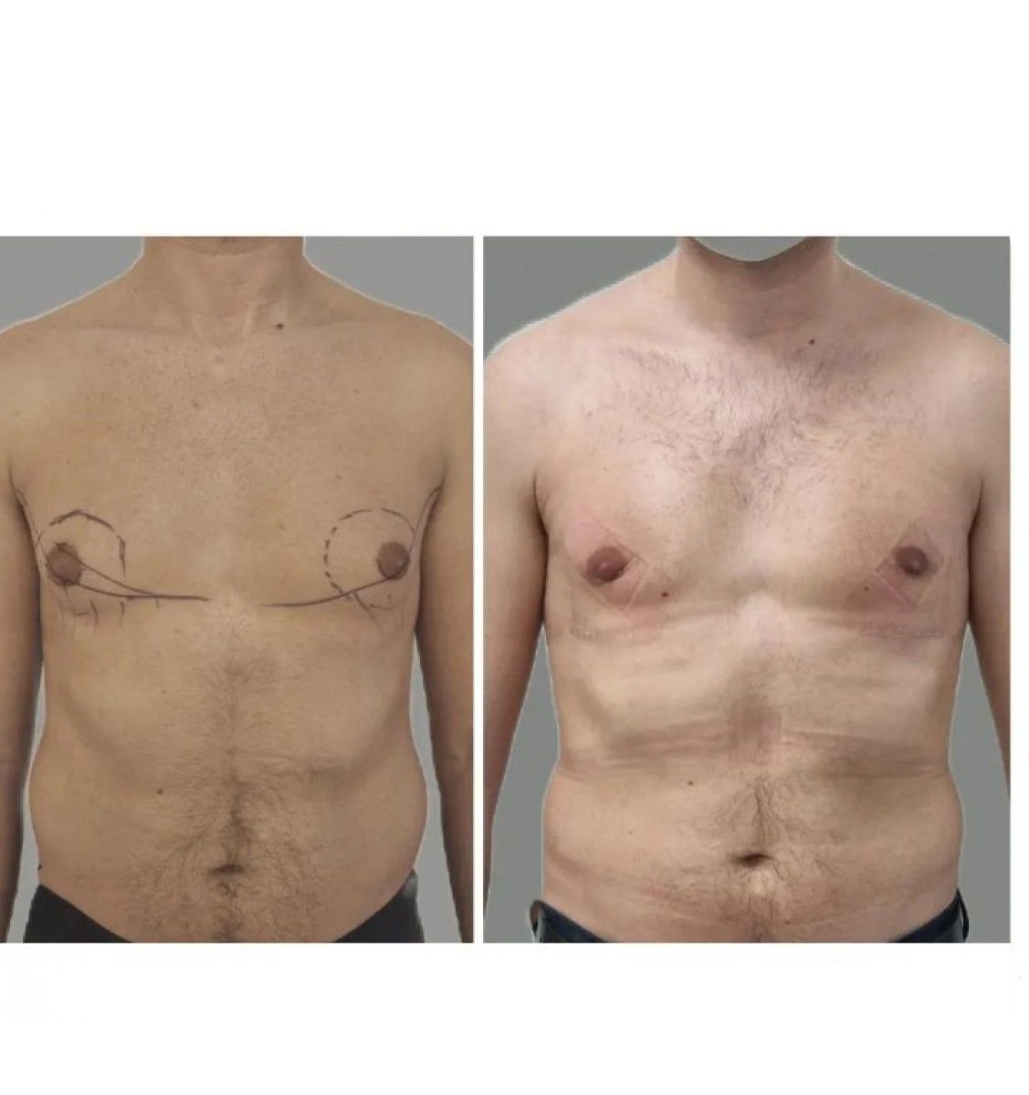 نتائج قبل وبعد جراحة التثدي في KCM Clinic – تحسين شكل صدر الرجل