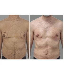 Résultats avant/après gynécomastie à KCM Clinic – contour thoracique masculin amélioré