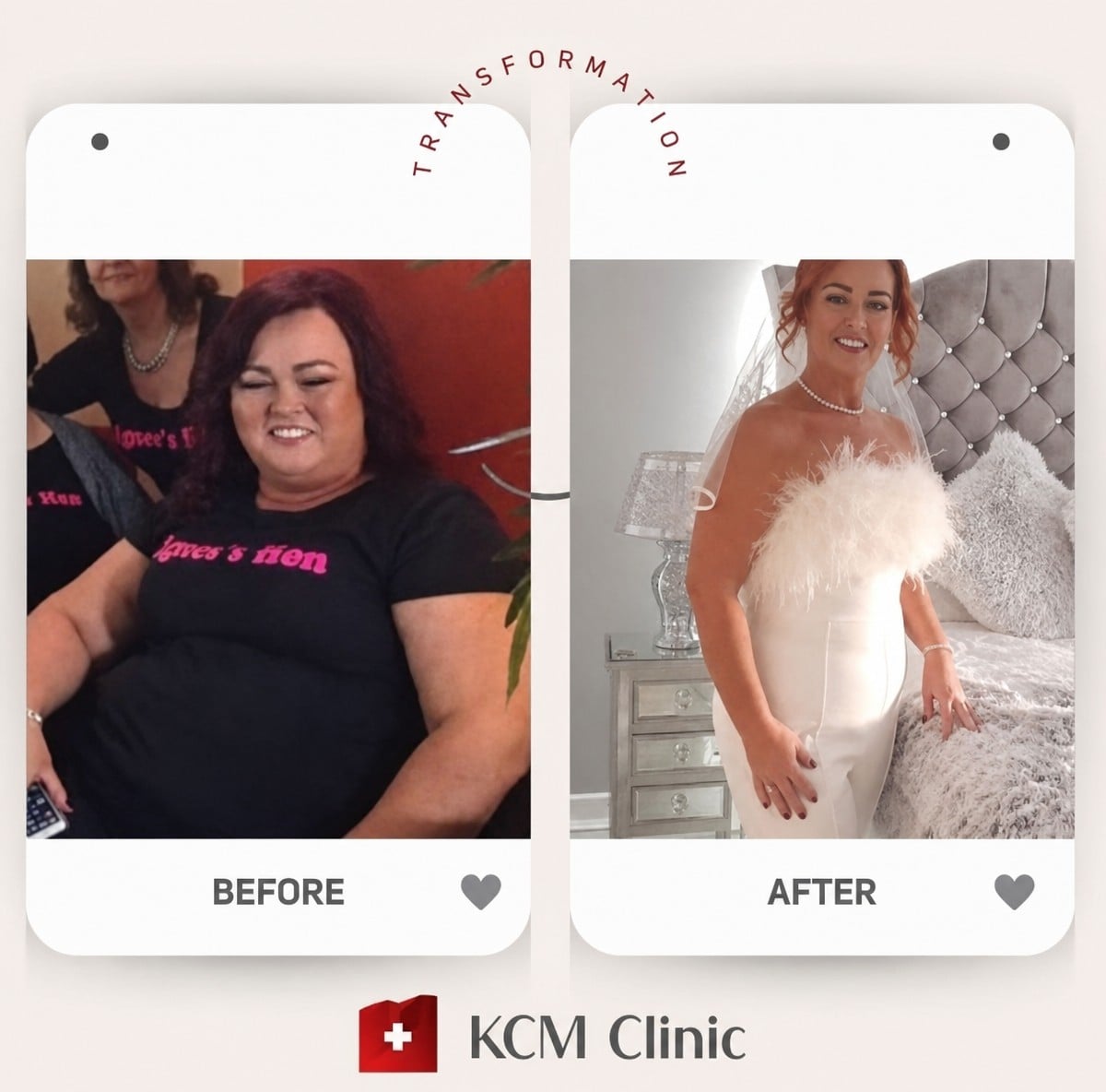 Resultados antes y después del balón gástrico en KCM Clinic: notable pérdida de peso