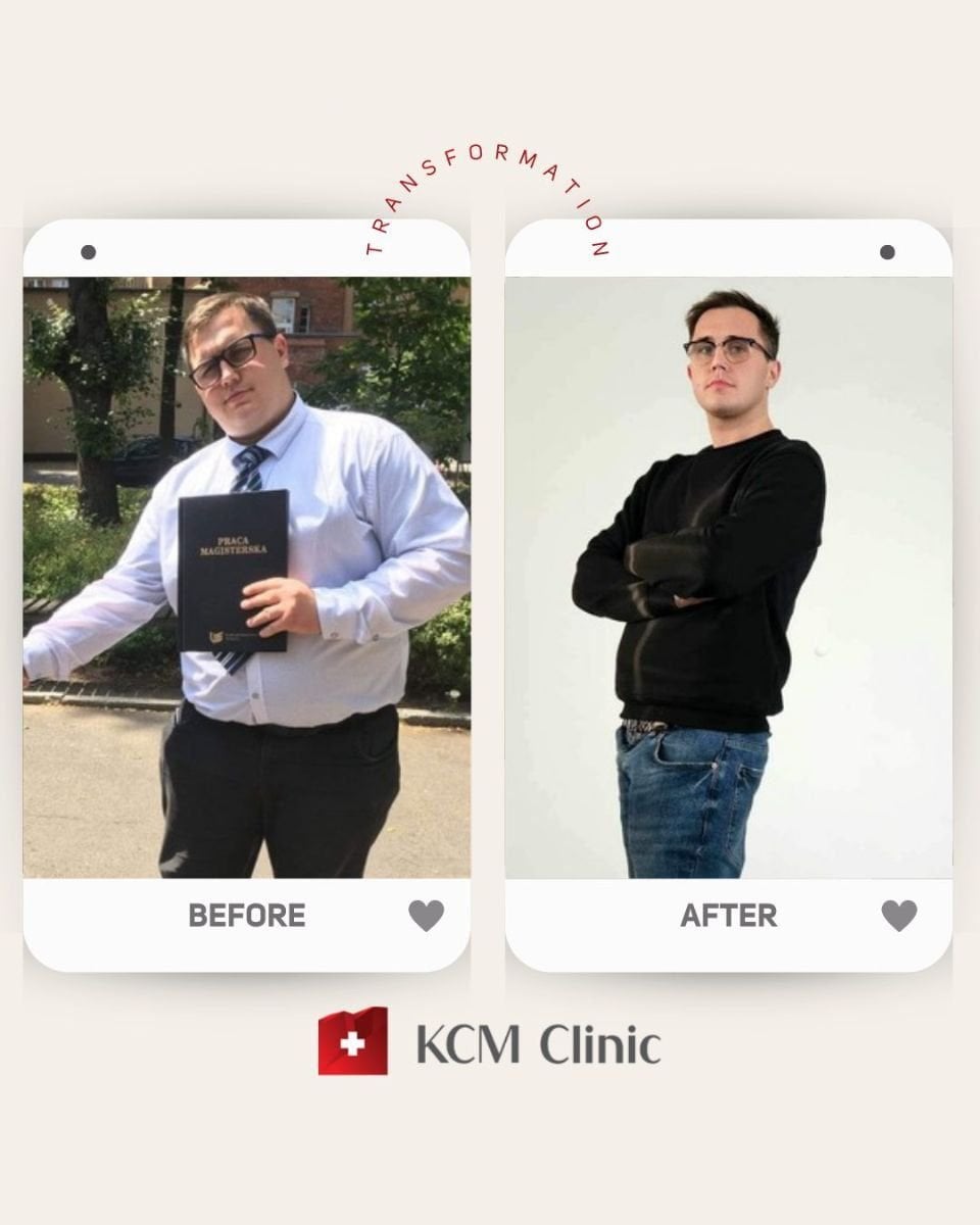 Resultados antes y después del balón gástrico en KCM Clinic: visible pérdida de peso