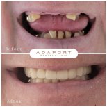 نتيجة قبل وبعد زراعة الأسنان All-on-4 في عيادة Adaport، استعادة الابتسامة