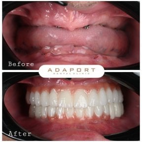 Before and after All-on-4 dental implants result at Adaport Dental Clinic, full smile restoration