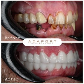 نتيجة قبل وبعد زراعة الأسنان All-on-4 في Adaport Dental Clinic، استعادة الابتسامة