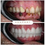 نتيجة قبل وبعد زراعة الأسنان All-on-4 في Adaport Dental Clinic، استعادة الابتسامة