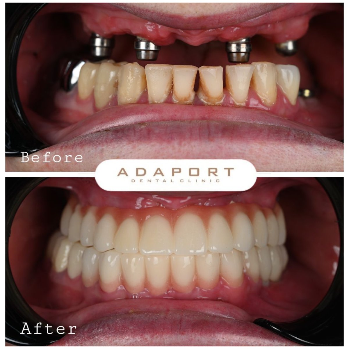 Resultados antes y después de implantes All-on-4 en Adaport Dental Clinic, restauración de sonrisa