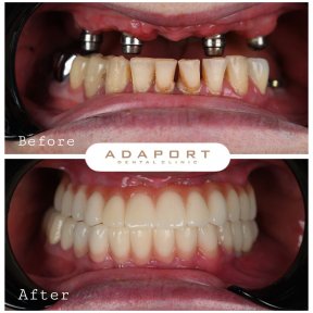 نتائج قبل وبعد زراعة أسنان All-on-4 في عيادة Adaport، استعادة الابتسامة