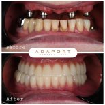 نتائج قبل وبعد زراعة أسنان All-on-4 في عيادة Adaport، استعادة الابتسامة
