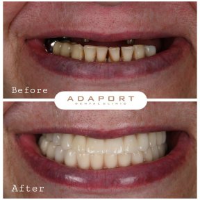 نتيجة قبل وبعد زراعة الأسنان All-on-4 في عيادة Adaport، استعادة الابتسامة