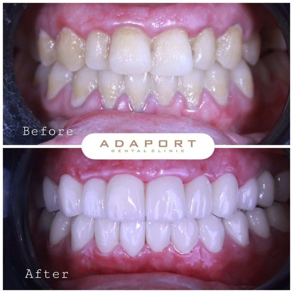 Antes y después de carillas Emax en Adaport Dental Clinic: resultados de sonrisa renovada