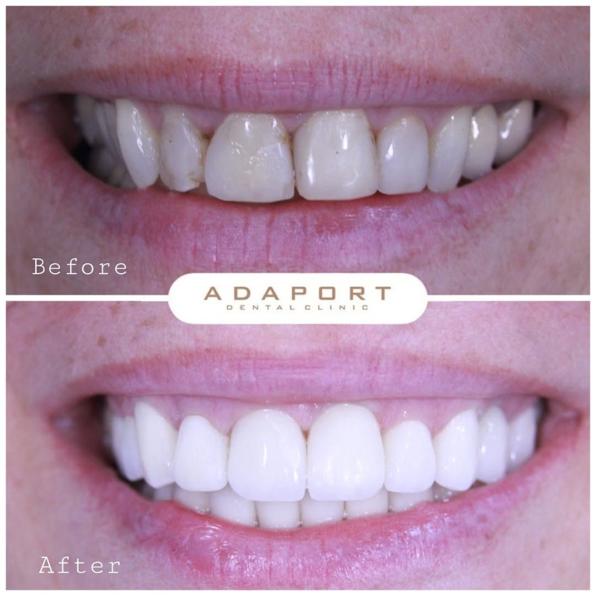 Resultado antes y después de carillas Emax en Adaport Dental Clinic – transformación de sonrisa