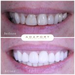 Before and after Emax veneers result at Adaport Dental Clinic – smile makeover transformation