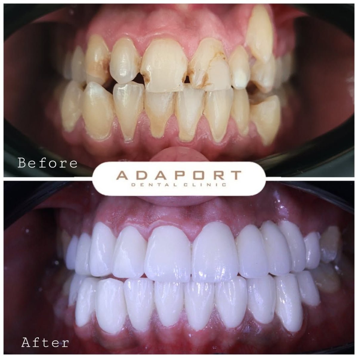 Antes y después de carillas Emax en Adaport Dental Clinic: resultados de sonrisa renovada