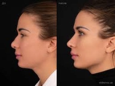Результаты ринопластики до и после в клинике Veselibu, улучшенная форма носа и профиль