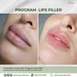 Before and after lip filler results at Plenary Wellness, enhanced lip volume and shape