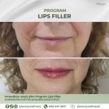 Before and after lips filler results at Plenary Wellness – enhanced lip volume and contour