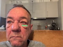 Lower eyelid blepharoplasty candidate at Quartz Hospital, visible under-eye bags before surgery