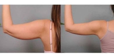 Resultados de lifting de brazos (braquioplastia) antes y después en ID Clinic Bangkok – mejor contorno