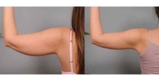 Resultados de lifting de brazos (braquioplastia) antes y después en ID Clinic Bangkok – mejor contorno