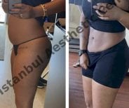 Before and after liposuction 3 body areas result at Istanbul Aesthetic Plastic Surgery Center