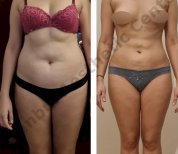 Результат ліпосакції 3 зон до і після в Istanbul Aesthetic Plastic Surgery Center
