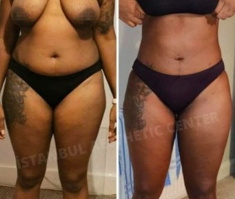 Результат липосакции 3 зон: до и после в Istanbul Aesthetic Plastic Surgery Center