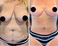 Результаты до и после абдоминопластики и подтяжки груди в Istanbul Aesthetic Plastic Surgery Center