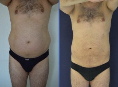 Результат липосакции 3 зон: до и после в Istanbul Aesthetic Plastic Surgery Center