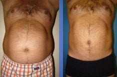 Результат липосакции 3 зон: до и после в Istanbul Aesthetic Plastic Surgery Center