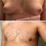 Efekty przed i po liposukcji Vaser ginekomastii w Istanbul Aesthetic Plastic Surgery Center