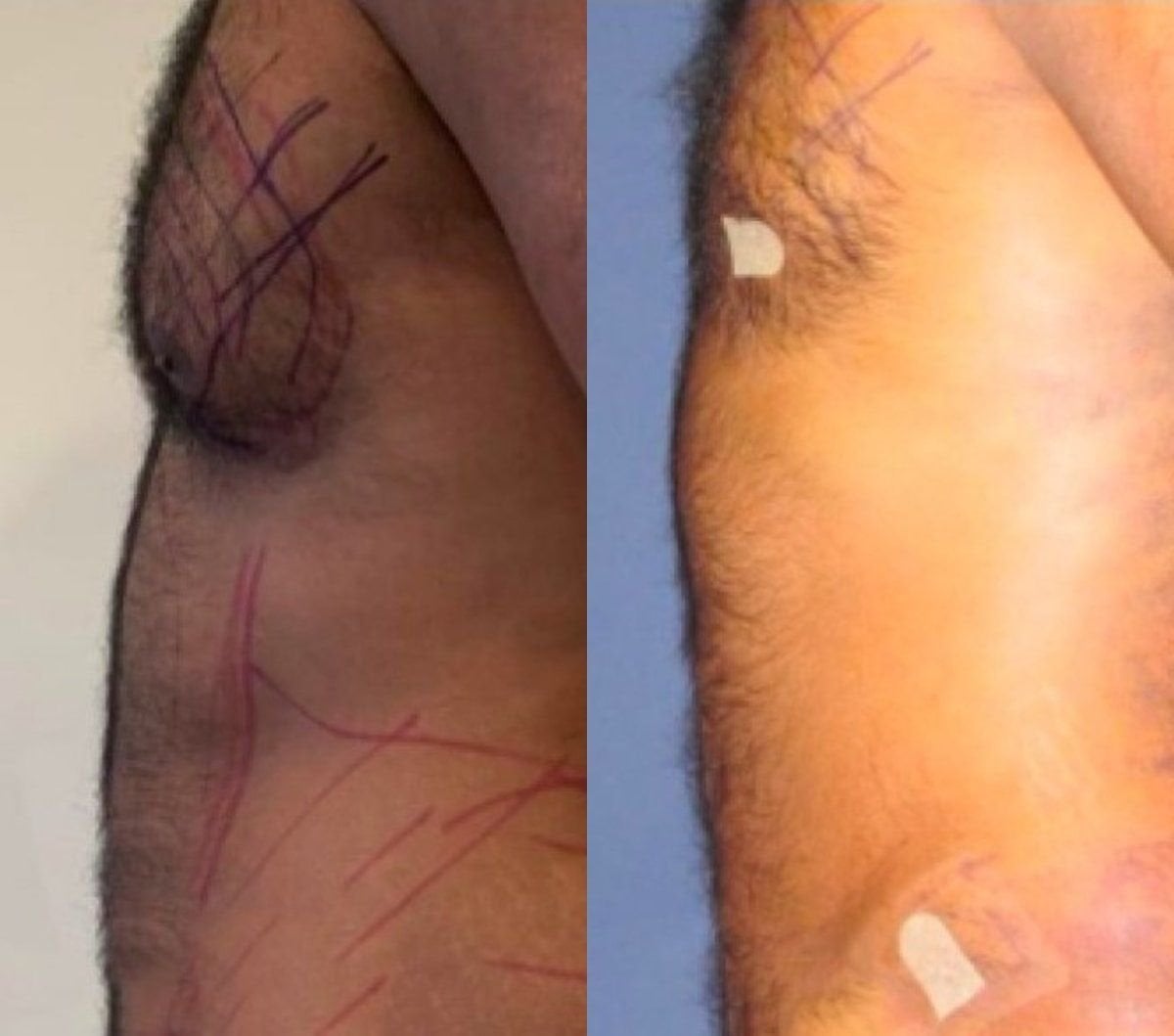 نتائج شفط الدهون فايزر لعلاج التثدي قبل وبعد في مركز إسطنبول للتجميل الجراحي