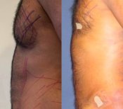 Результати до і після Vaser-ліпосакції гінекомастії в Istanbul Aesthetic Plastic Surgery Center