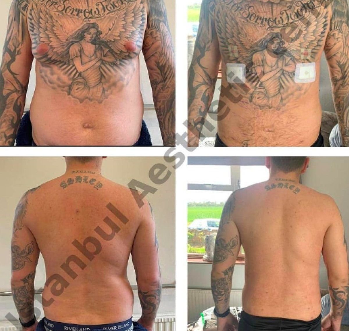 Resultados antes y después de liposucción Vaser para ginecomastia en Istanbul Aesthetic Plastic Surgery Center