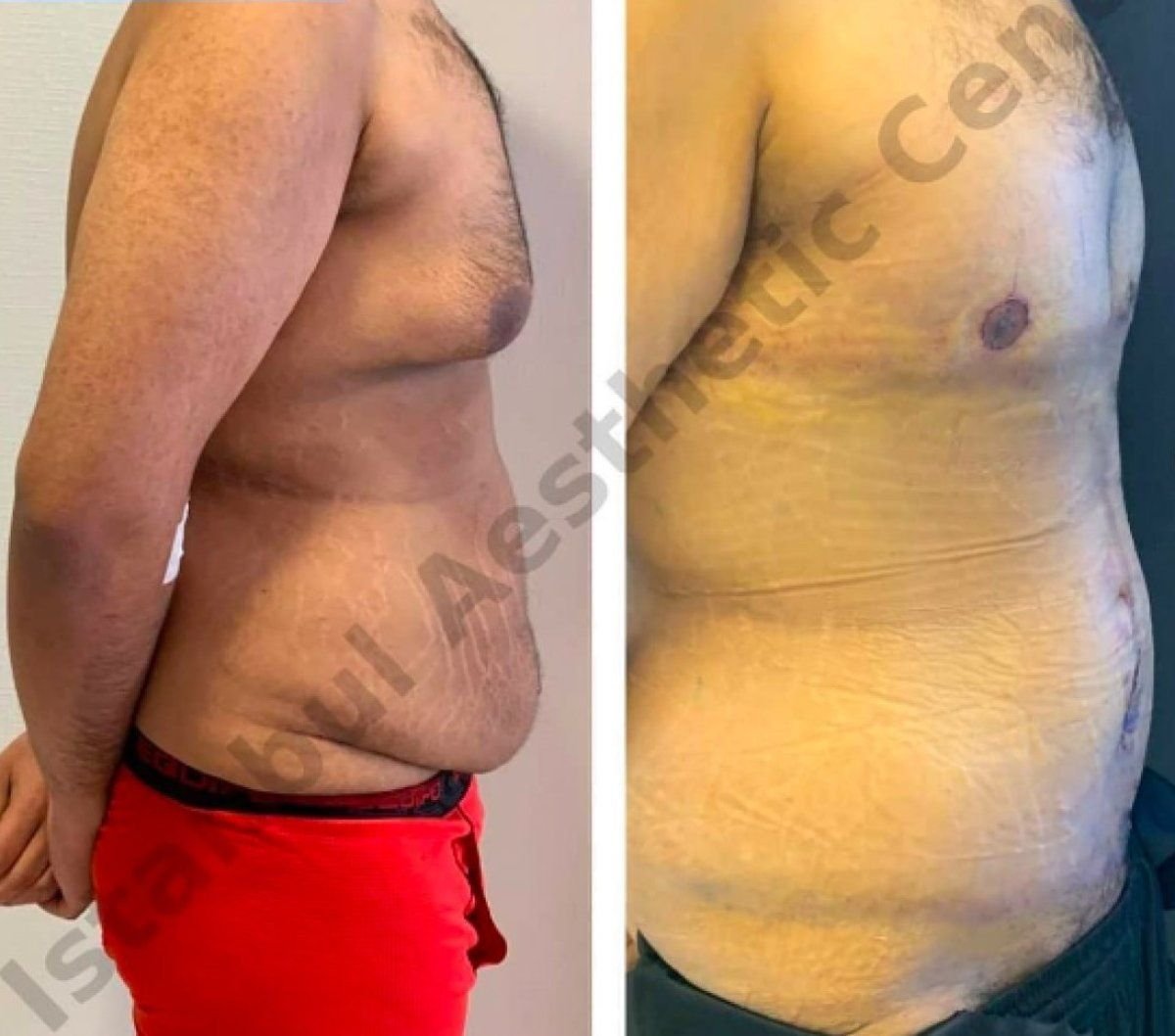 نتائج شفط الدهون فايزر لعلاج التثدي قبل وبعد في مركز إسطنبول للجراحة التجميلية