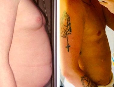 Efekty przed i po liposukcji Vaser ginekomastii w Istanbul Aesthetic Plastic Surgery Center