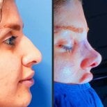 Before and after Septoplasty (Deviated Septum Surgery) photos by Dr. 
