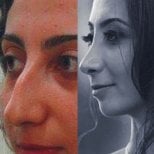 Результаты до и после септопластики в Istanbul Aesthetic Plastic Surgery Center, улучшена форма носа