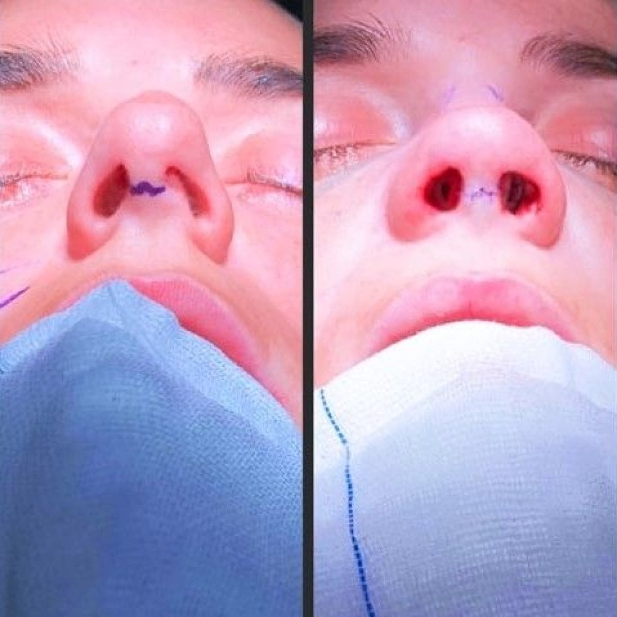 نتائج قبل وبعد عملية تصحيح الحاجز الأنفي في Istanbul Aesthetic Plastic Surgery Center وتحسن التنفس