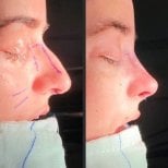 Before and after Septoplasty (Deviated Septum Surgery) photos by Dr. 