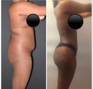 Результати до і після кругової підтяжки тіла в Istanbul Aesthetic Plastic Surgery Center