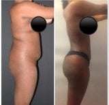 Результати до і після кругової підтяжки тіла в Istanbul Aesthetic Plastic Surgery Center