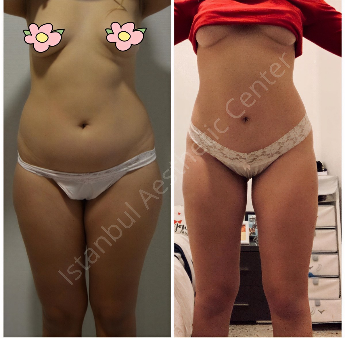 Resultados antes y después de full body lift en Istanbul Aesthetic Plastic Surgery Center, contorno corporal