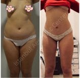 Before and after full body lift results at Istanbul Aesthetic Plastic Surgery Center, body contouring